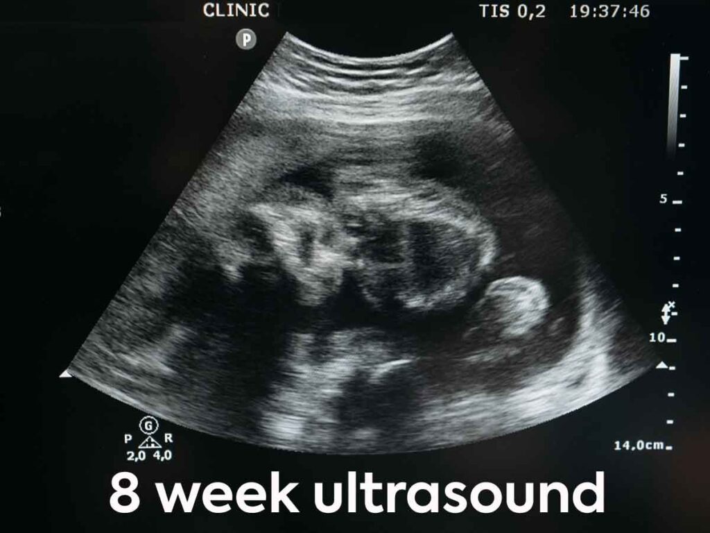 What Does an 8 Week Ultrasound Look Like