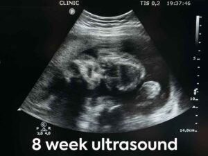 8 week ultrasound looks like